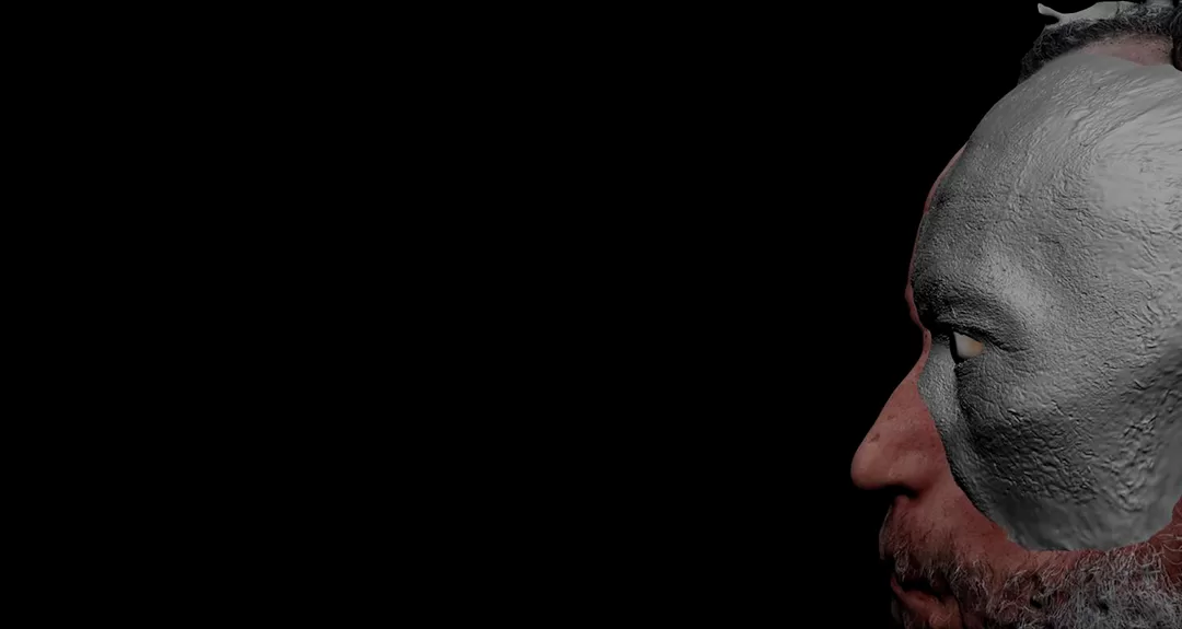 HA reabilita paciente com prótese facial moldada com tecnologia 3D