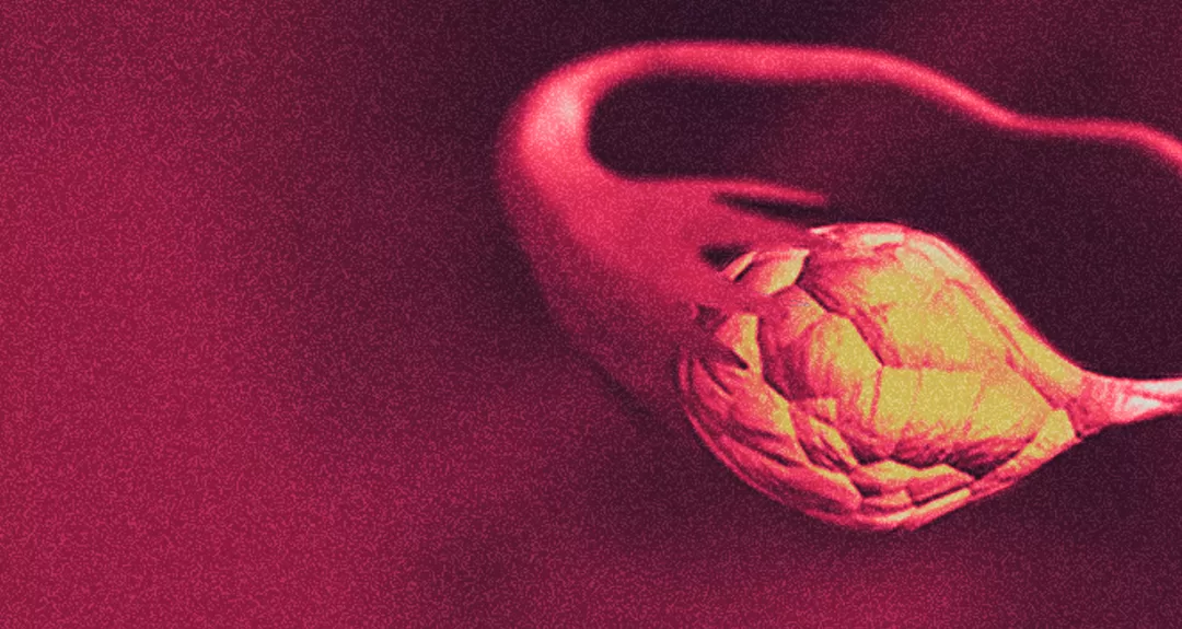 Câncer de ovário: prevalência e desafios no Brasil