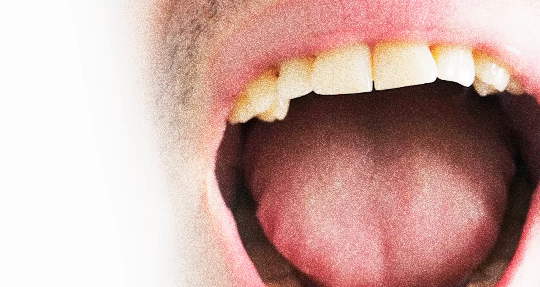 Câncer de Boca: conheça o programa de rastreamento do Hospital de Amor