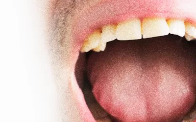 Câncer de Boca: conheça o programa de rastreamento do Hospital de Amor